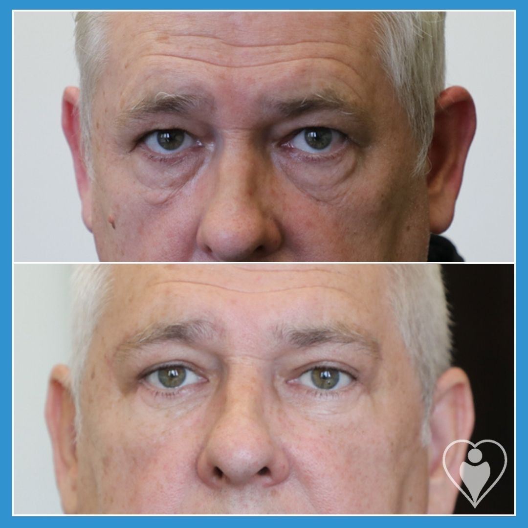 Eyelid Surgery at Istanbul European Clinic