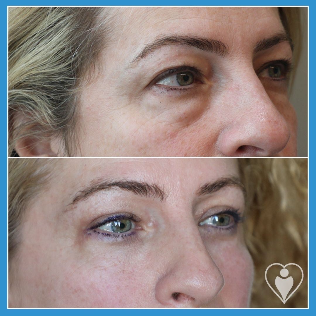 Eyelid Surgery at Istanbul European Clinic