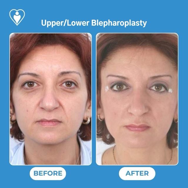 Eyelid Surgery at Luna Clinic Turkey