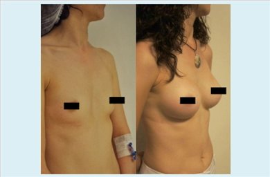Breast Implants at Estethica Atasehir