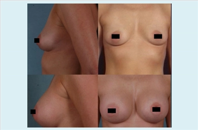 Breast Implants at Estethica Atasehir
