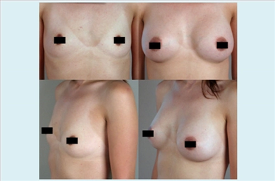Breast Implants at Estethica Atasehir