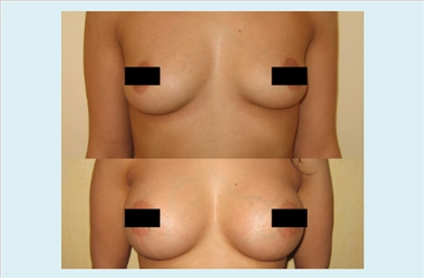 Breast Implants at Estethica Atasehir