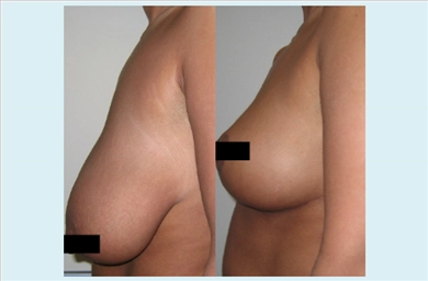Breast Implants at Estethica Atasehir