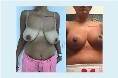 Breast Implants at Mediface Health Group