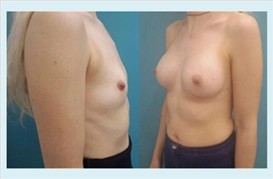 Breast Implants at Mediface Health Group