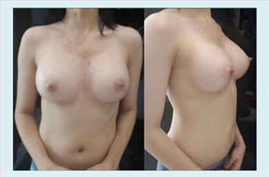 Breast Implants at Mediface Health Group
