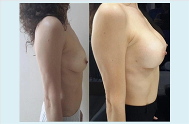 Breast Implants at Mediface Health Group