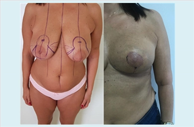 Breast Implants at Mediface Health Group