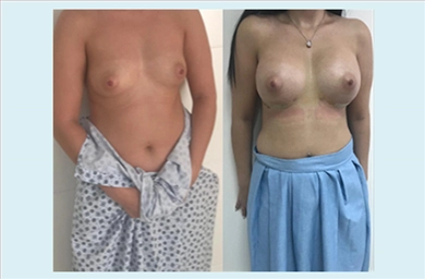 Breast Implants at Mediface Health Group