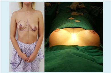 Breast Implants at Mediface Health Group