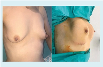 Breast Implants at Memorial Sisli Hospital