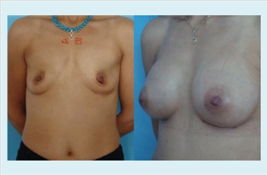 Breast Implants at Memorial Sisli Hospital