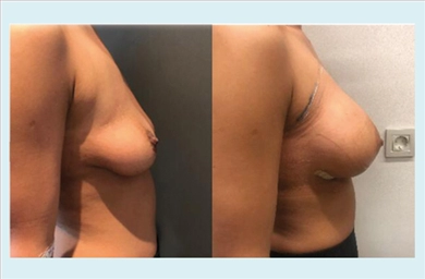 Breast Implants at Memorial Sisli Hospital
