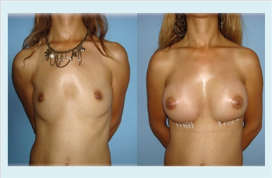 Breast Implants at Memorial Sisli Hospital