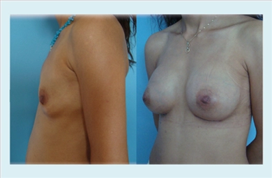 Breast Implants at Memorial Sisli Hospital