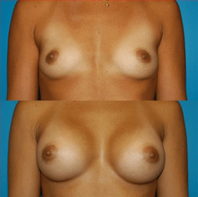 Breast Implants at Luna Clinic Turkey