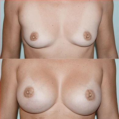Breast Implants at Luna Clinic Turkey