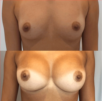 Breast Implants at Luna Clinic Turkey