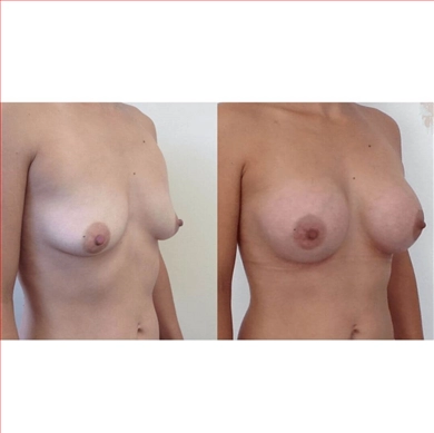 Breast Implants at Luna Clinic Turkey