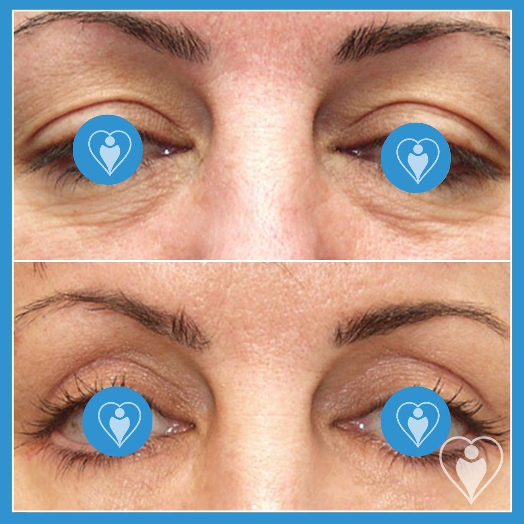 Eyelid Surgery at Istanbul European Clinic