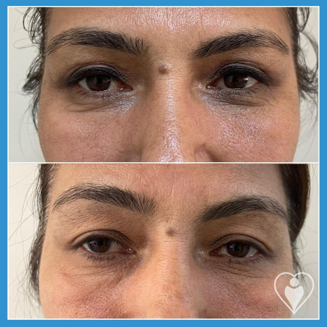 Eyelid Surgery at Luna Clinic Turkey