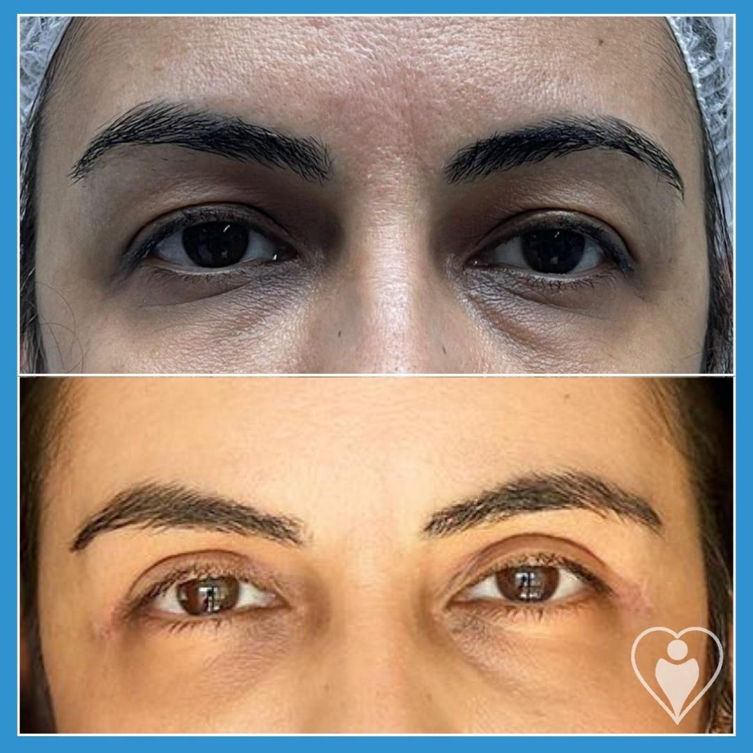 Eyelid Surgery at Luna Clinic Turkey
