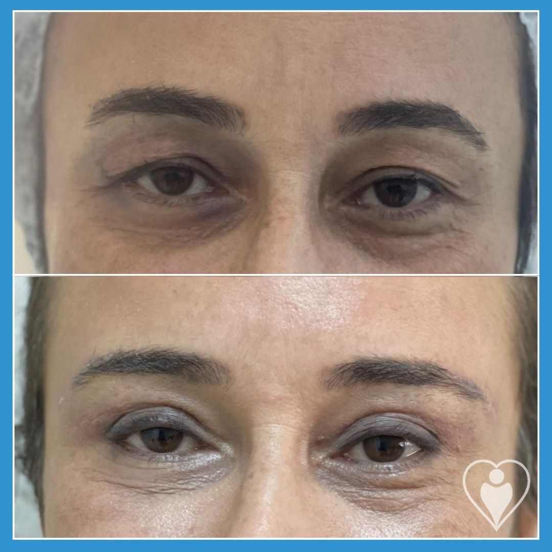 Eyelid Surgery at Luna Clinic Turkey