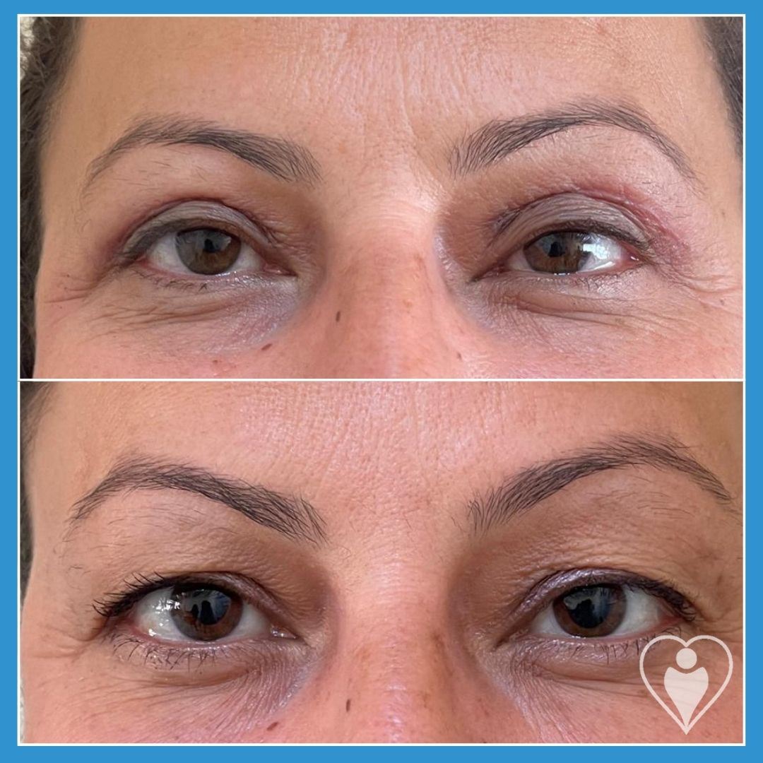 Eyelid Surgery at Luna Clinic Turkey