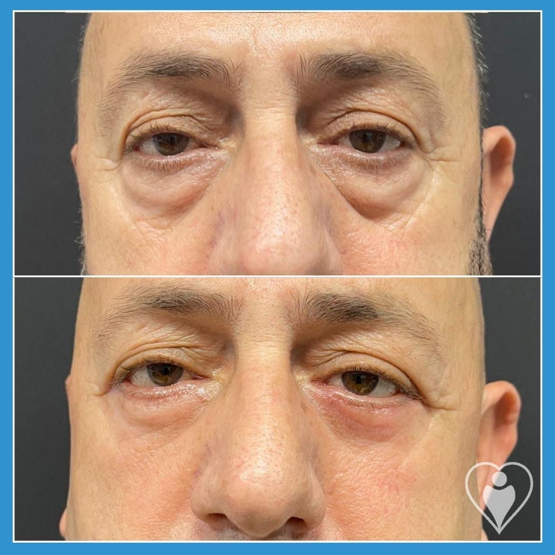 Eyelid Surgery at Luna Clinic Turkey