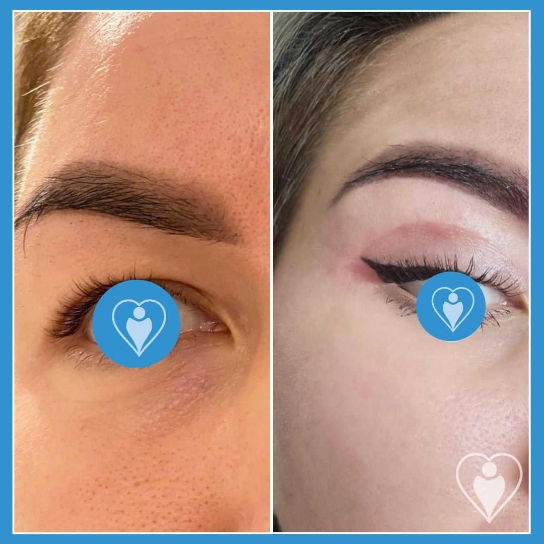 Eyelid Surgery at Luna Clinic Turkey