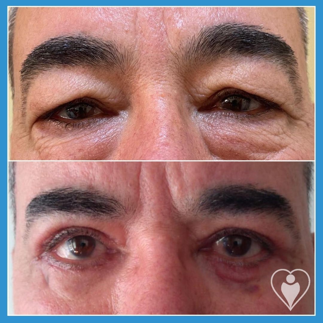 Eyelid Surgery at Luna Clinic Turkey