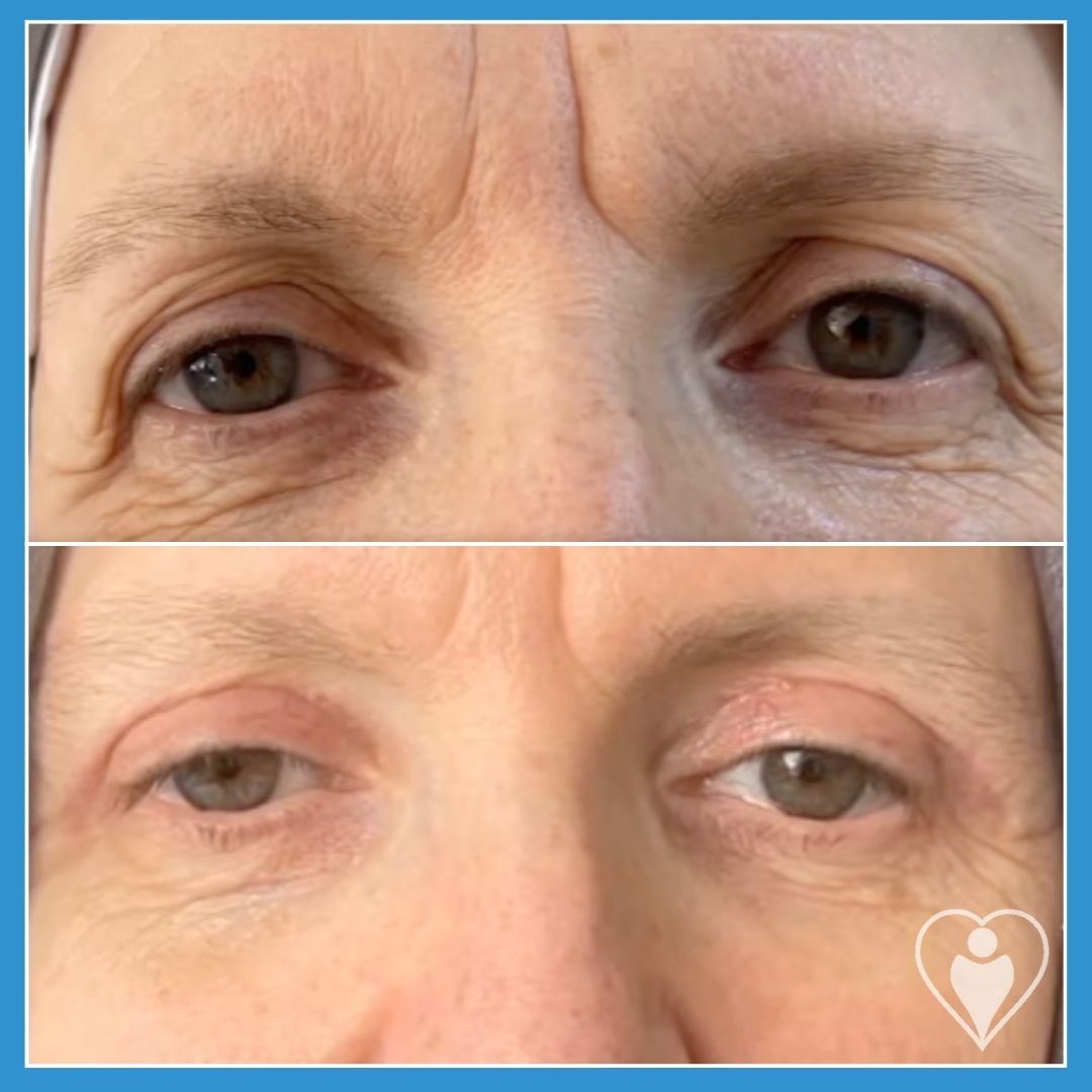 Eyelid Surgery at Luna Clinic Turkey