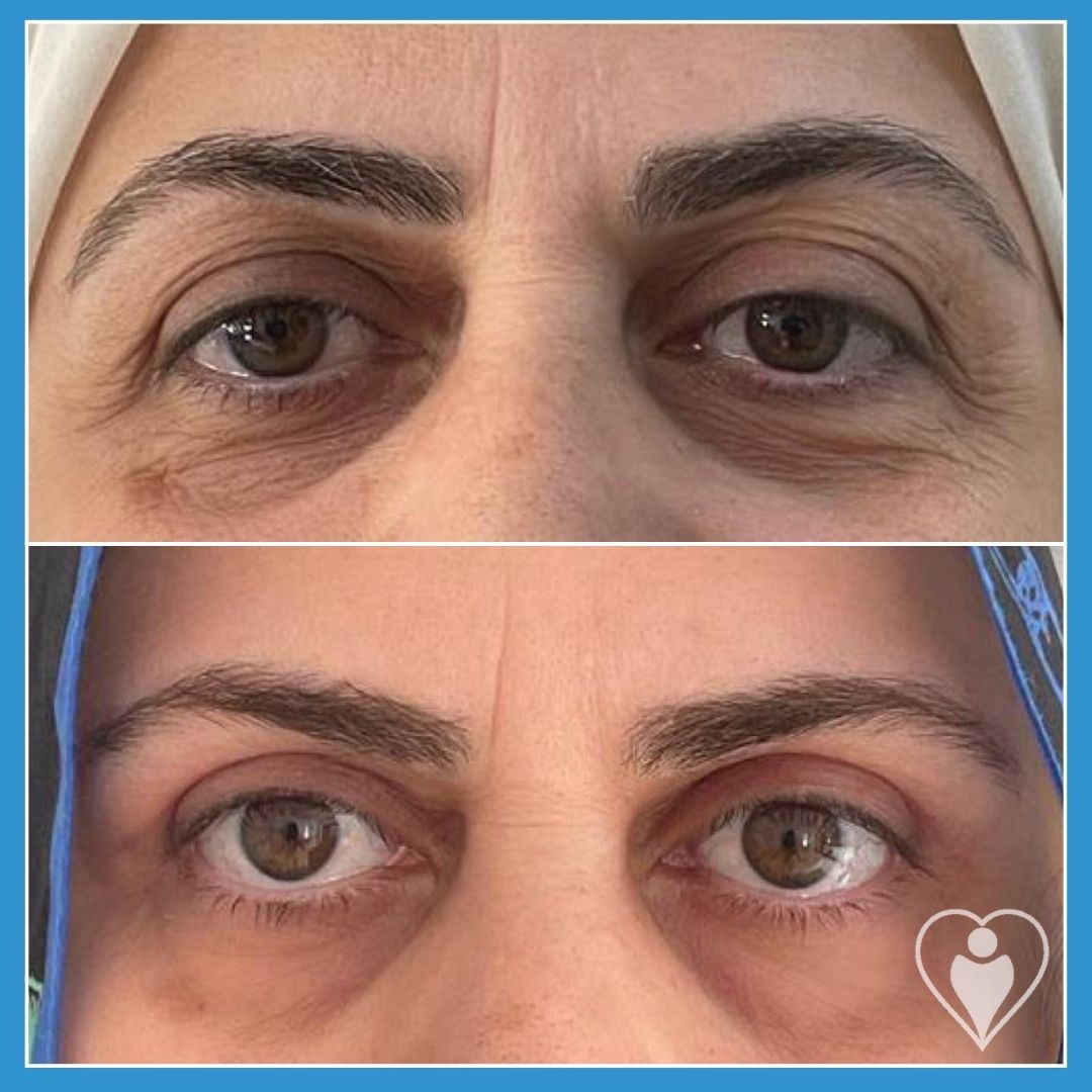 Eyelid Surgery at Luna Clinic Turkey