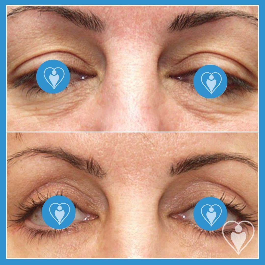Eyelid Surgery at Luna Clinic Turkey