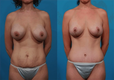 Breast Implants at Luna Clinic Turkey