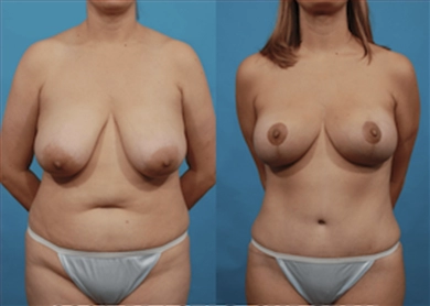 Breast Implants at Luna Clinic Turkey