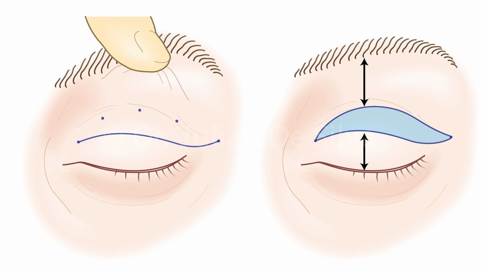 Cover image for Things You Should Know About Eyelid Surgery